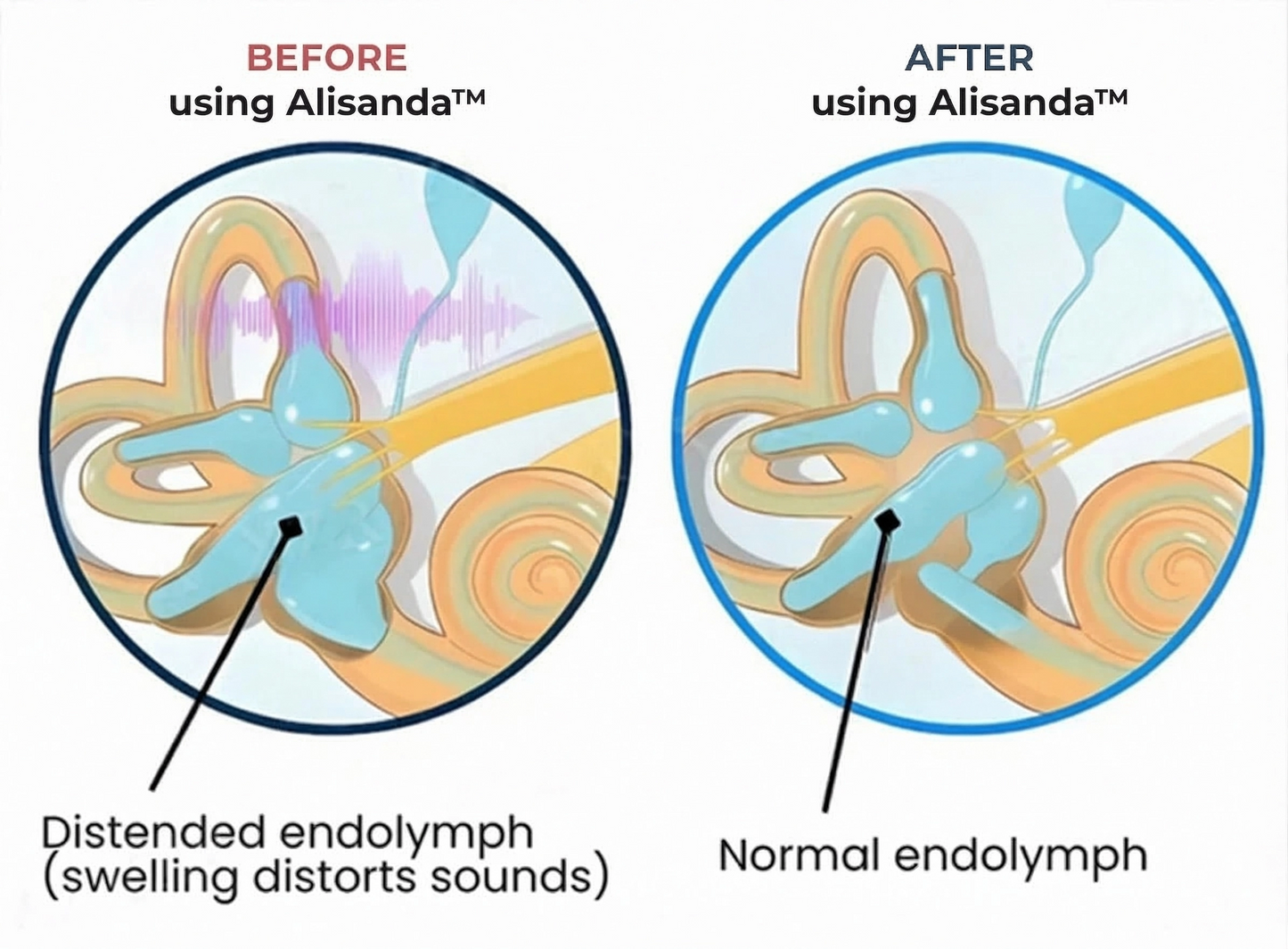 Alisanda®💓HAPPY 2026💓 Tinnitus Relieving Device