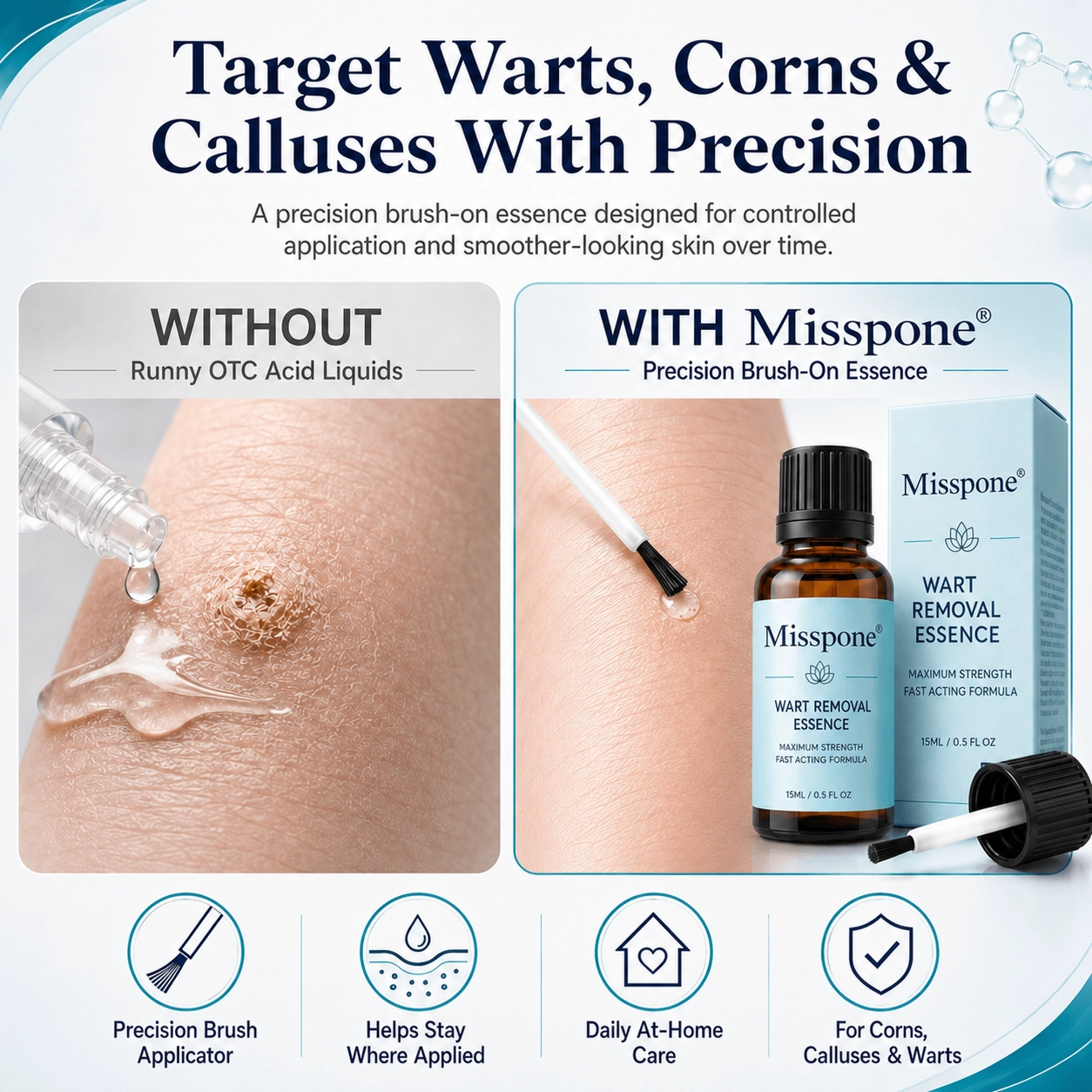 Stop Cursing the Sting: The Precision Acid That Destroys Corns & Warts Without the Burn