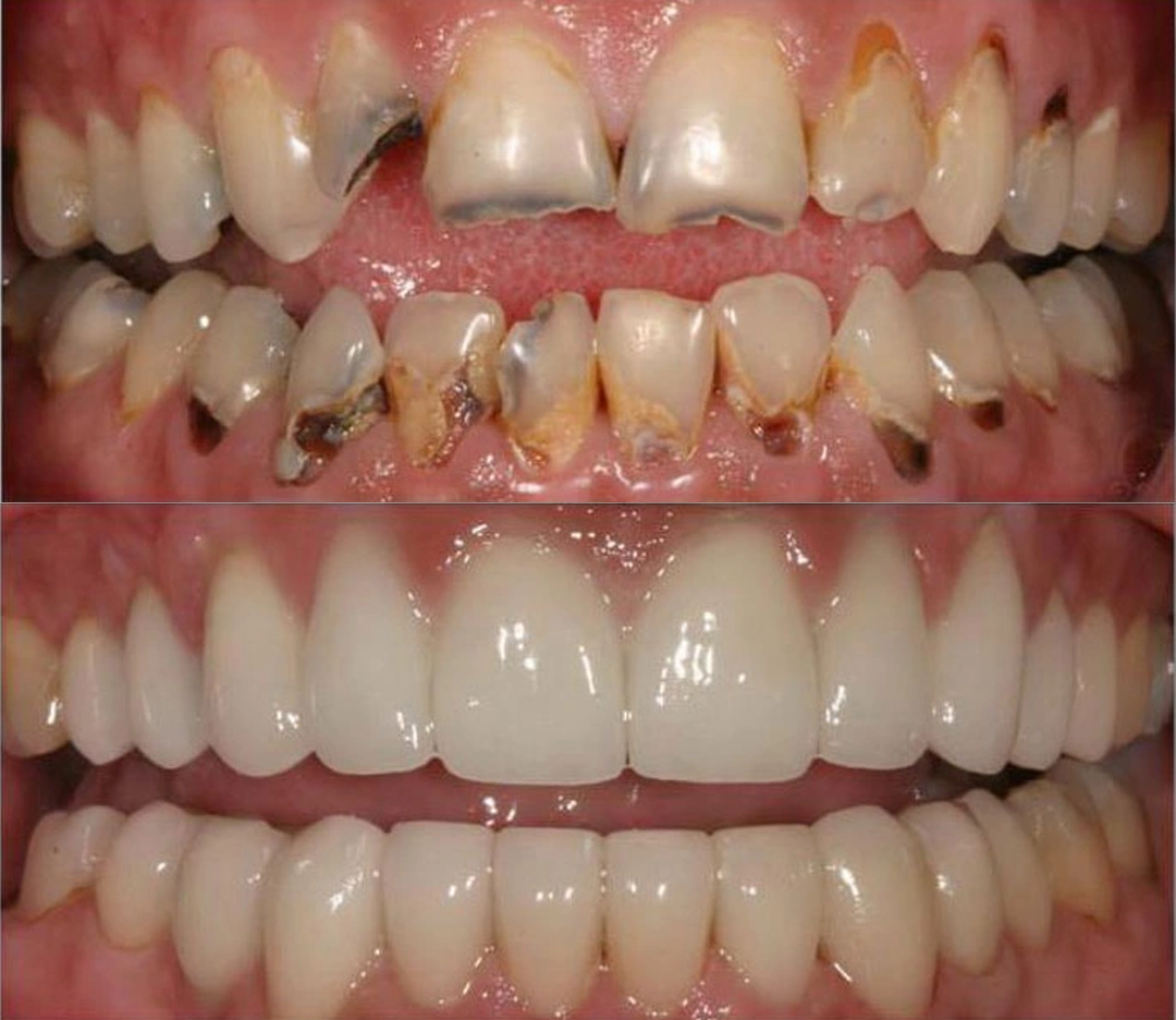 ⏰Last 4 hours Sale: Save 50%-Skavix® SensiGum Fluoride Toothpaste