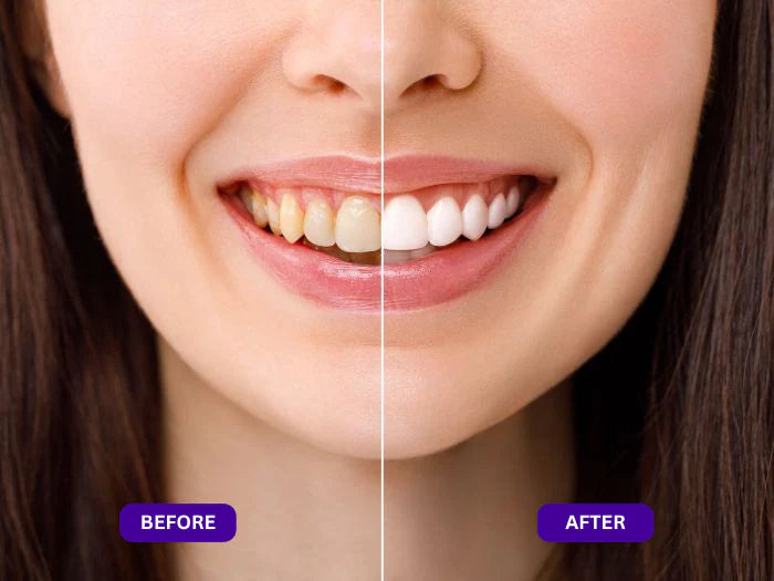Divifit™ Purple Whitening Strips