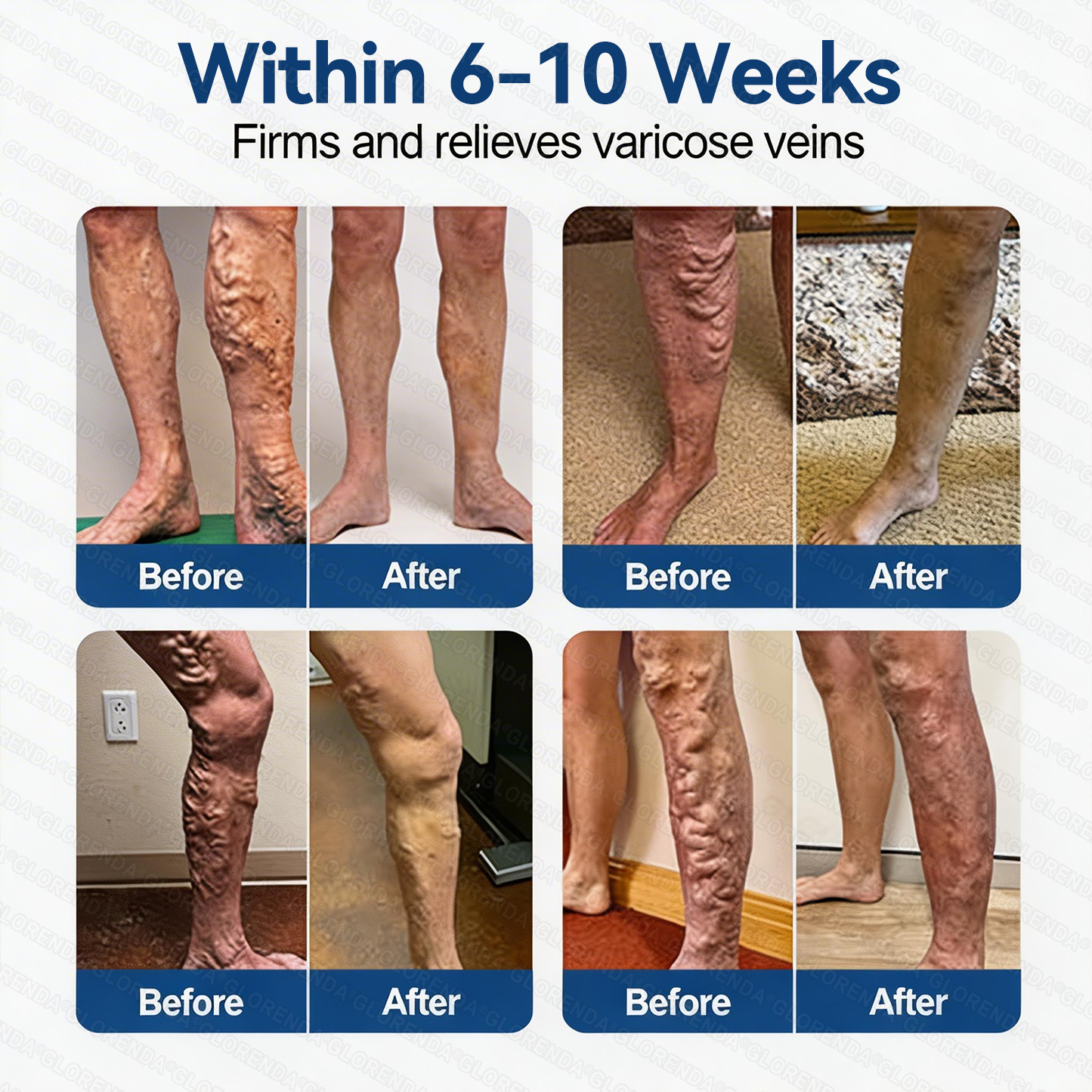 Alisanda® 𝑽𝗲𝗶𝙣 𝘾𝐨𝐧𝘁𝗼𝙪𝙧 𝙈𝙞𝐜𝐫𝒐𝒏𝒆𝗲𝗱𝗹𝙚 𝙋𝙖𝐭𝐜𝒉 𝒘𝒊𝘁𝗵 𝗔𝙙𝙫𝙖𝙣𝙘𝐞𝐝 𝐃𝒊𝒐𝒔𝗺𝙞𝐧 & 𝑯𝒆𝘀𝗽𝗲𝙧𝙞𝙙𝙞𝐧 𝐃𝒆𝒍𝒊𝒗𝗲𝗿𝙮🌿𝟕-𝐃𝐚𝐲 𝐕𝐢𝐬𝐢𝐛𝐥𝐞 𝐑𝐞𝐬𝐮𝐥𝐭𝐬 𝐟𝐨𝐫 𝐕𝐚𝐫𝐢𝐜𝐨𝐬𝐞 𝐕𝐞𝐢𝐧𝐬